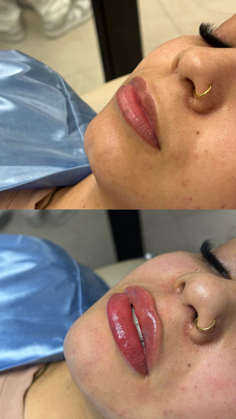 Resultado de preenchimento labial — lábios naturais com volume definido